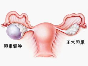 卵巢囊腫會變成卵巢癌嗎？